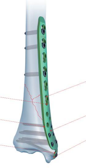 Дистально-медіальна великогомілкова пластина ліва ( Double Medical Technology Inc.)